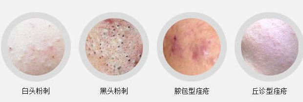 脸上长痘痘了怎么办?老想用手扣挤,可是会有痘坑痘印。脸上长痘痘难道就应该不管不顾嘛。怎么让自己不长痘痘,怎么让痘痘退下去那。你有没有痘痘越长越多的烦恼那,怎么不长痘痘那。总所周知,痘痘又命痤疮,是毛囊皮脂腺单位的一种慢性炎症性皮肤病,主要好发于青少年,对青少年的心理和社交影响很大,但青春期后往往能自然减轻或康复。临床表现以好发于面部的粉刺、丘疹、脓疱、结节等多形性皮损为特点。