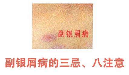 副银屑是什么