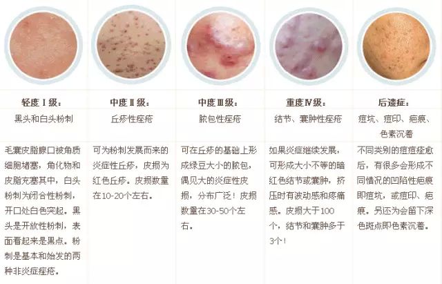 满脸的痘痘注意做好这五点