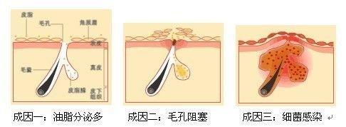 长痘痘的原因,长痘痘怎么办