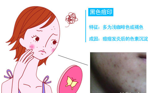 面部痤疮痘印如何措施