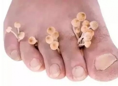 手足癣发病时有什么症状