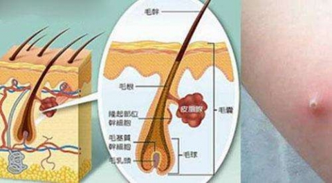 毛囊炎丘疹有什么特征