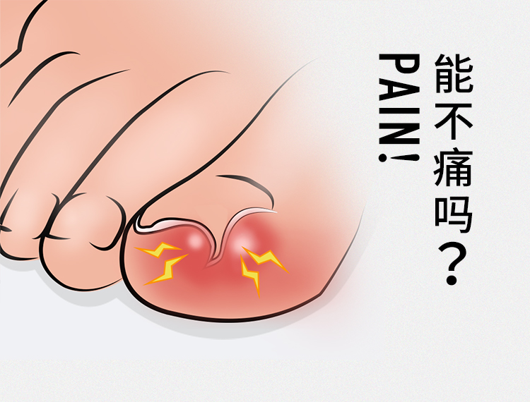 灰指甲的预防措施有哪些